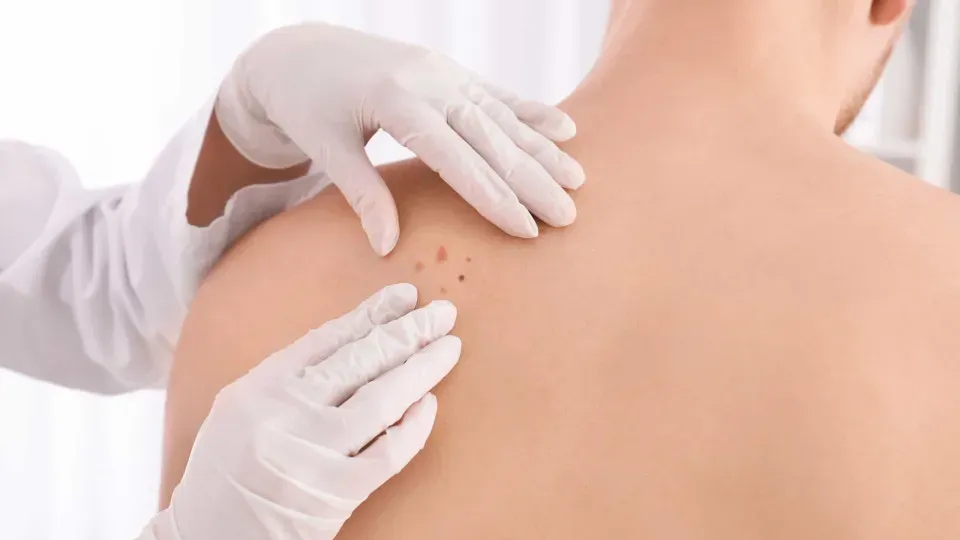 Médico lista sinais simples para saber se uma pinta é câncer de pele